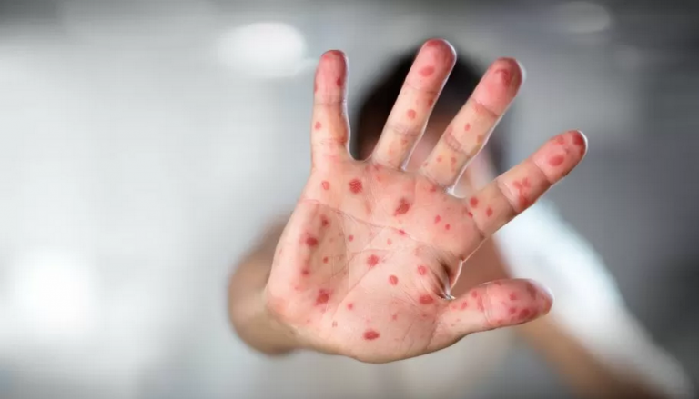 Ministerio de Salud confirma tercer caso de viruela del mono en Ecuador